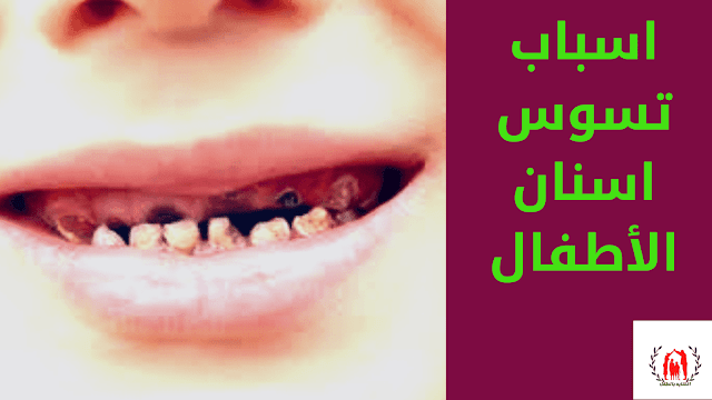 اسباب تسوس اسنان الأطفال