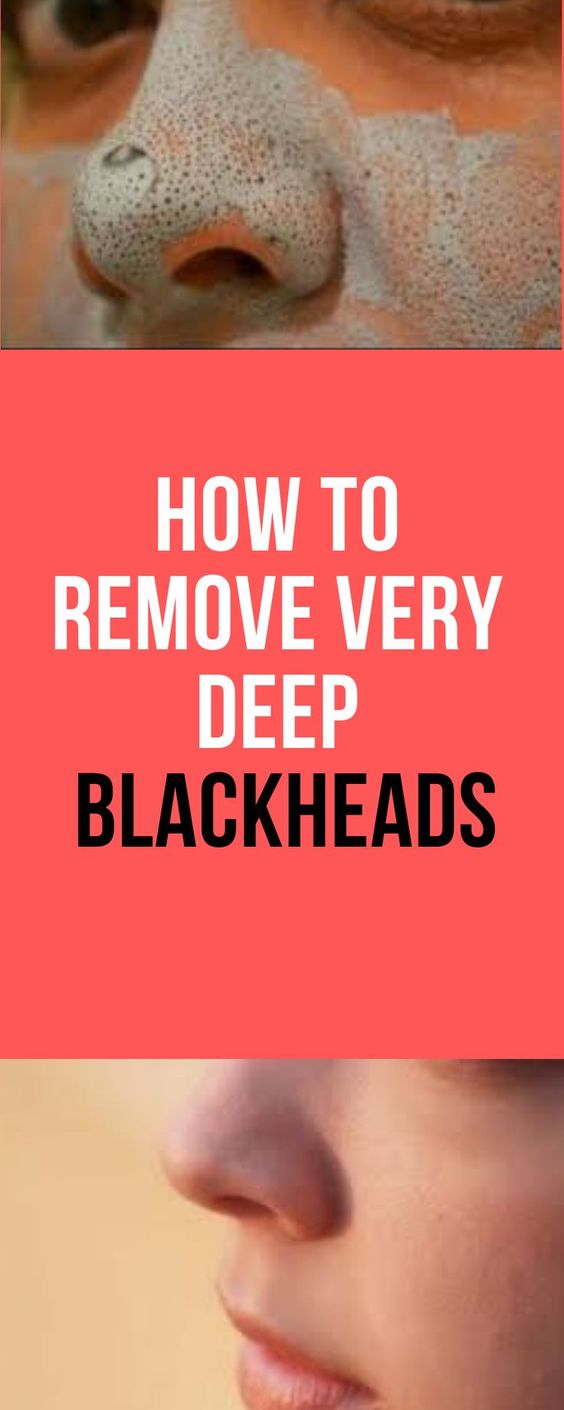 How To Remove Very Deep Blackheads Healthy Remedies