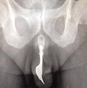 Incrivel homem passa por cirurgia para retirar garfo de dentro do pênis