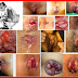 Artikel Tentang Obat Sakit Wasir Denature thumbnail