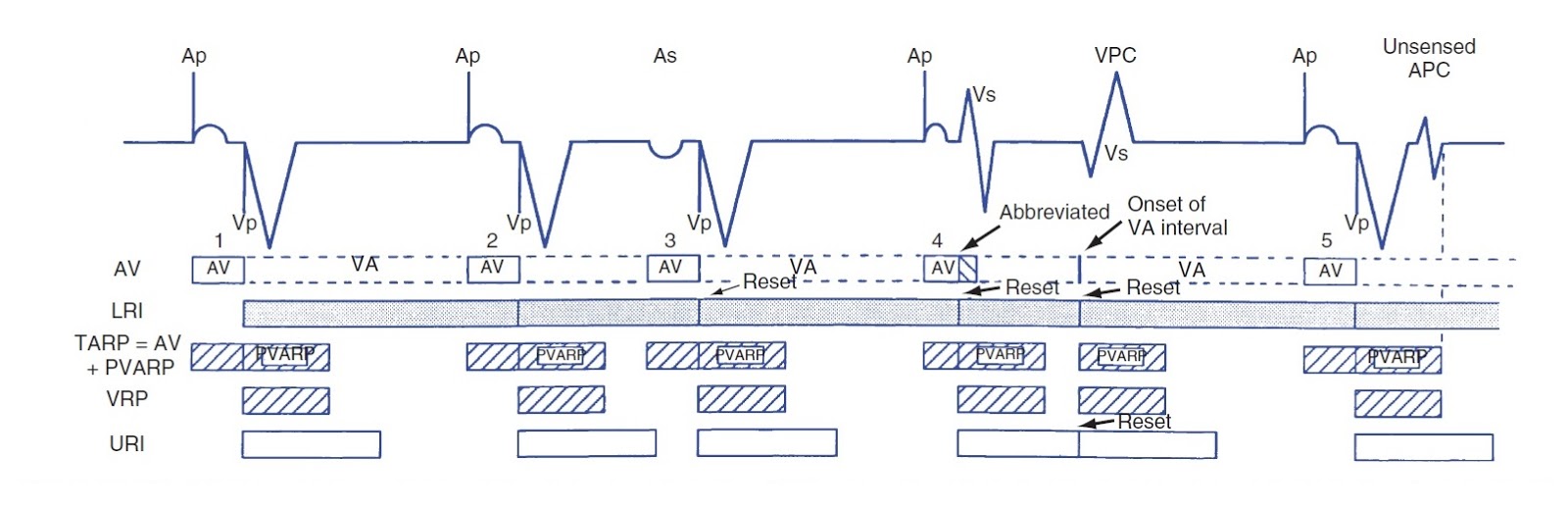 ECG Rhythms Interesting Pacemaker Behavior
