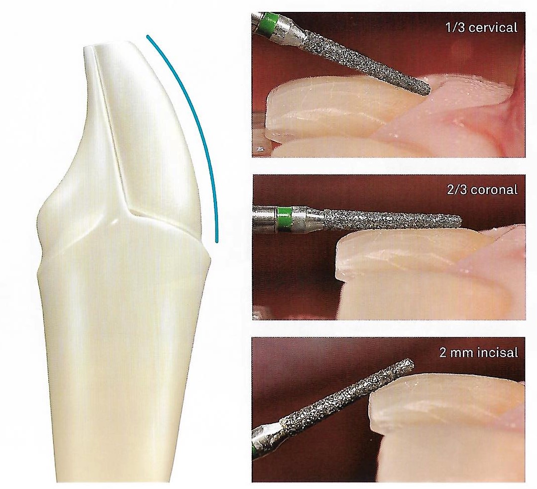 Ceramic veneers preparartion .. Part 2 " Conventional preparation