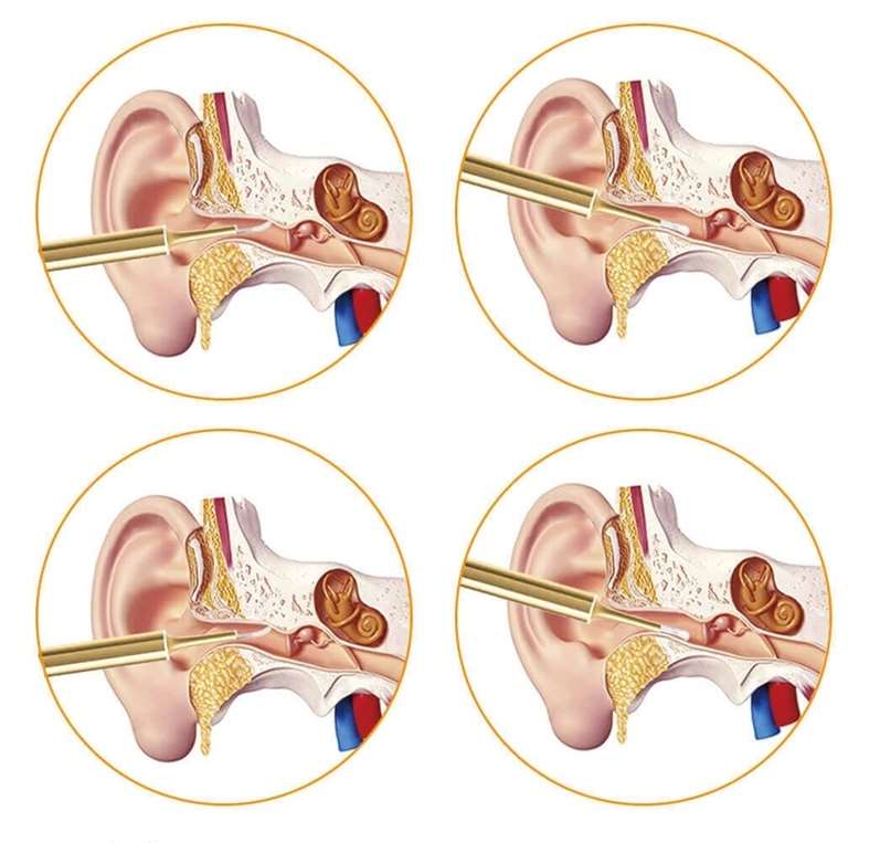 Dụng cụ lấy ráy tai thông minh Xiaomi Bebird X7 Pro Dụng cụ lấy ráy tai thông minh Xiaomi Bebird X7 Pro