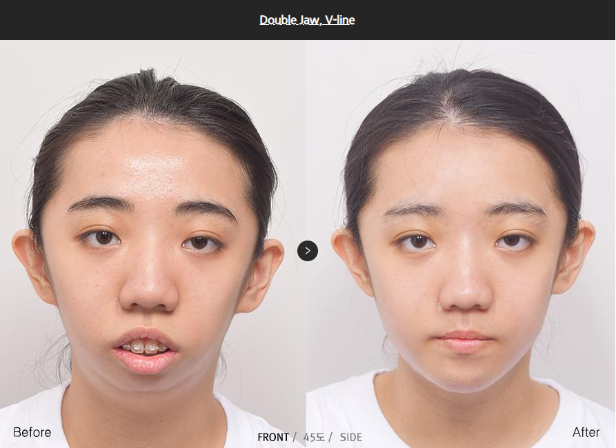 What is protruded mouth? (double jaw surgery, vline surgery, jaw