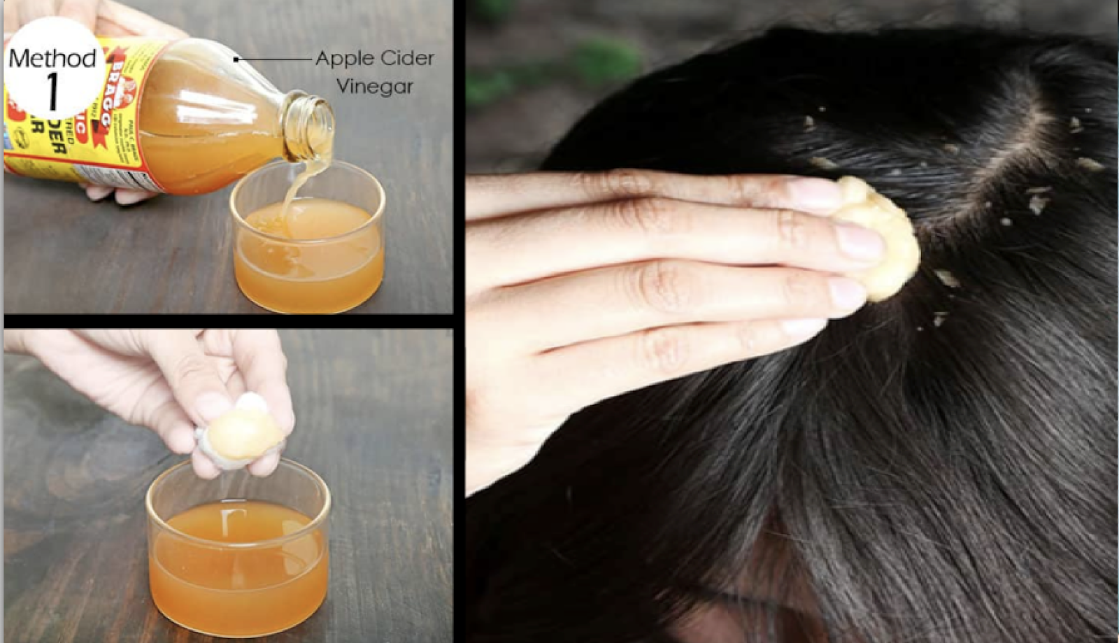 Head Lice and Dandruff Step By Step To Remove Head Lice And Dandruff Using Apple Cider Vinegar
