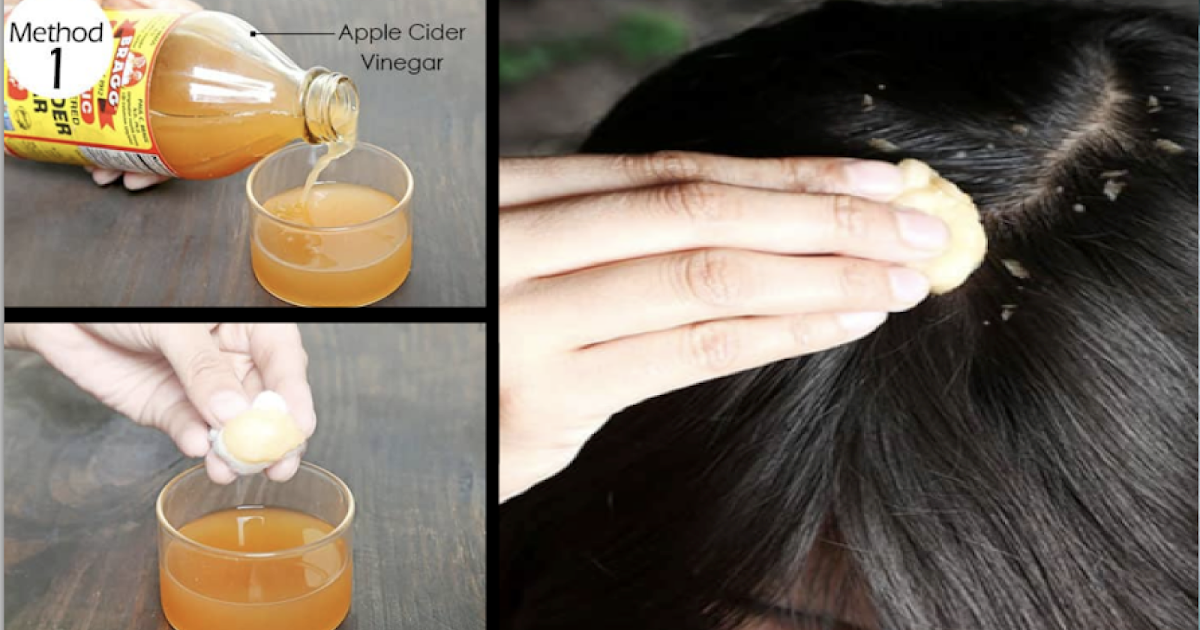 Head Lice and Dandruff Step By Step To Remove Head Lice And Dandruff