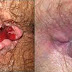 BAB Berdarah? Tanda Ambeyen thumbnail