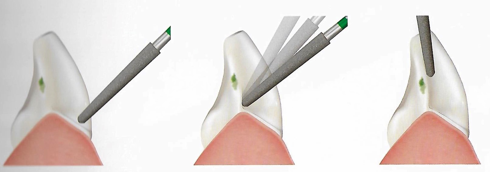 Ceramic veneers preparartion .. Part 2 " Conventional preparation