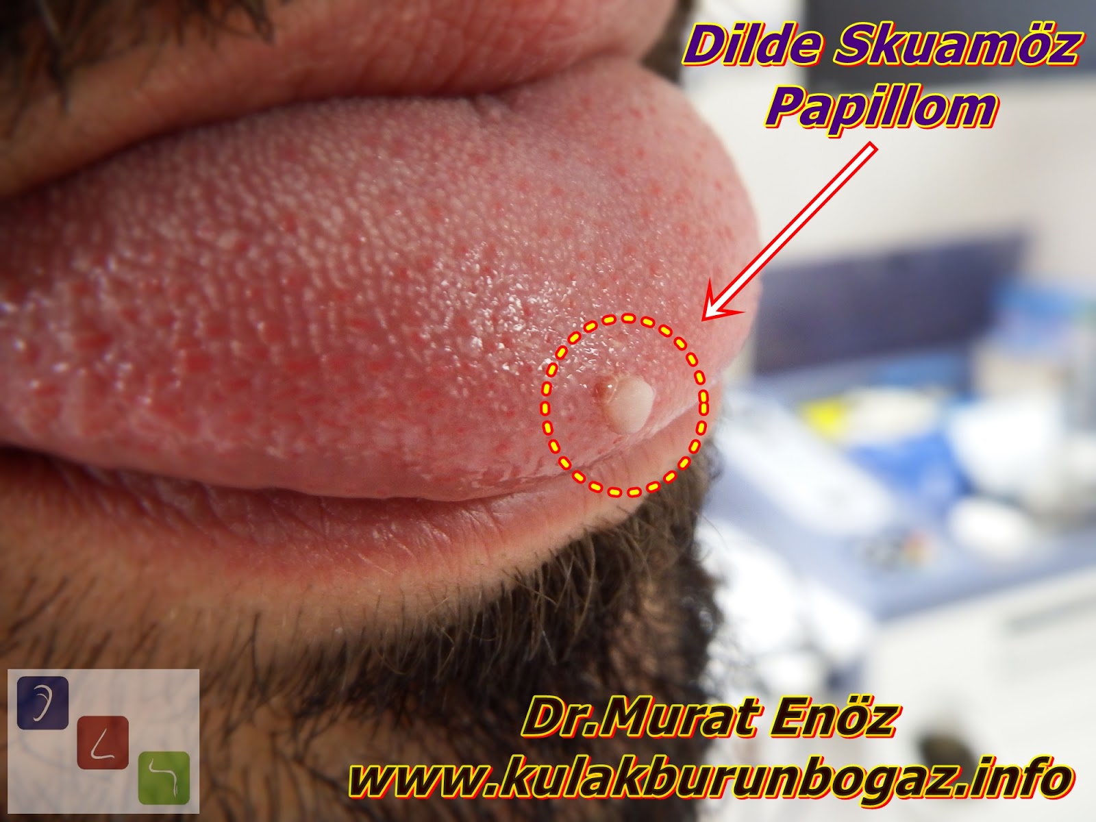 Squamous papilloma tip of tongue