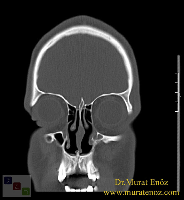 Boş burun sendromu tanımı - Boş burun sendromu belirtileri - Boş burun sendromu tedavisi - Boş burun sendromu tedavisinde Hyaluronik Asit dolgusu - Burun eti dolgusu - Treatment of Empty nose syndrome with hyaluronic acid filler - Boş burun - Geniş burun boşluğu sendromu - Burun eti büyütülmesi - Empty Nose Syndrome (ENS)