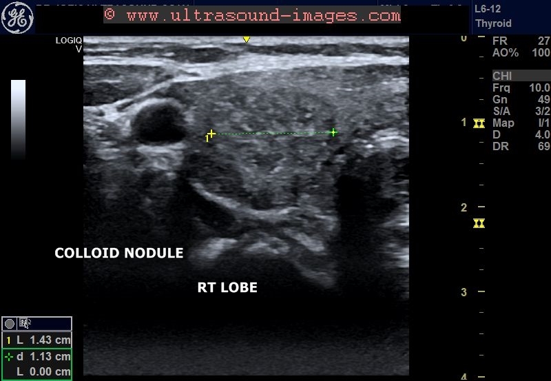 Ultrasound imaging Multiplecolloidnodulesthyroid