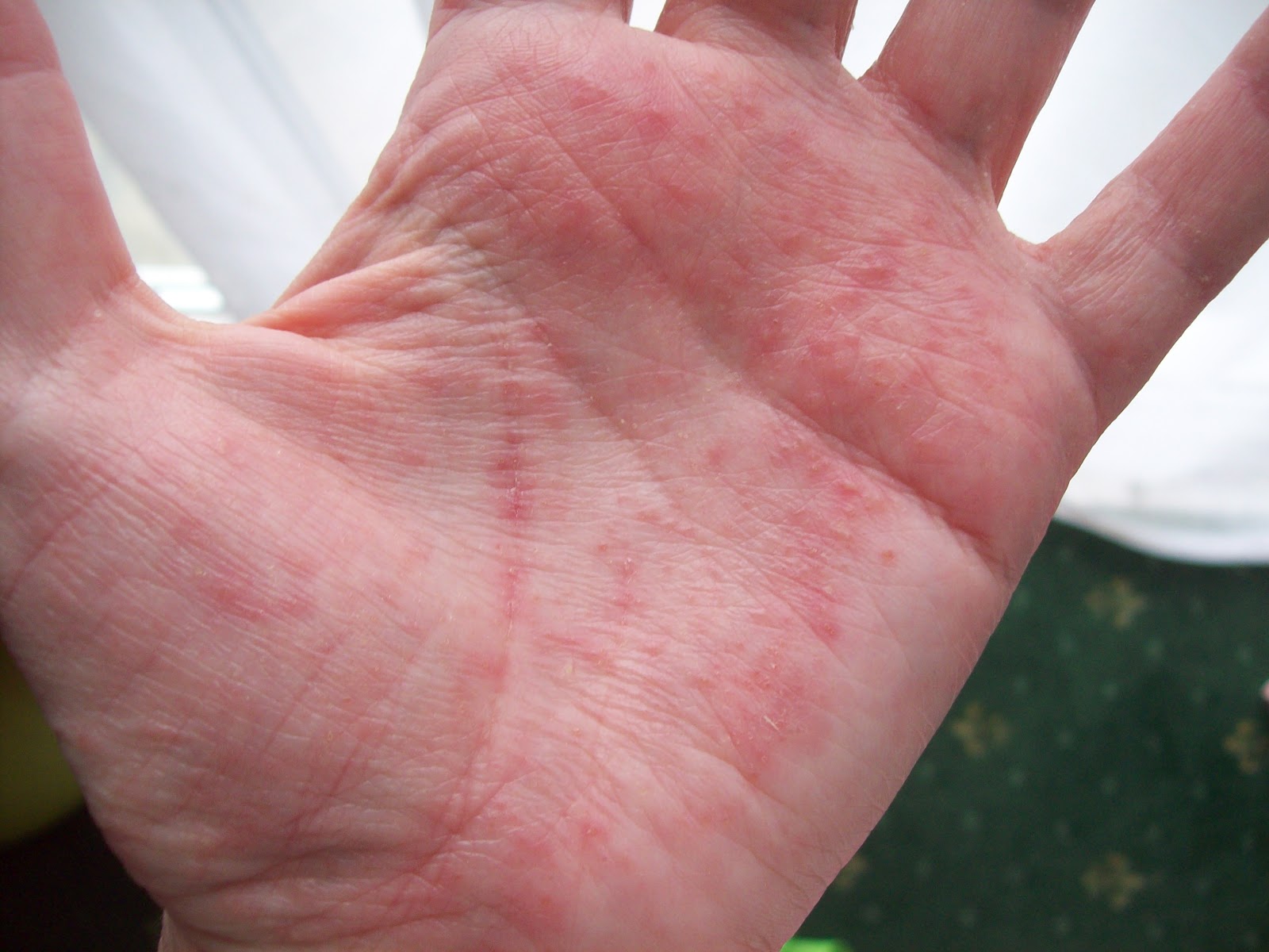 What can cause red spots on the palms of the hands ...