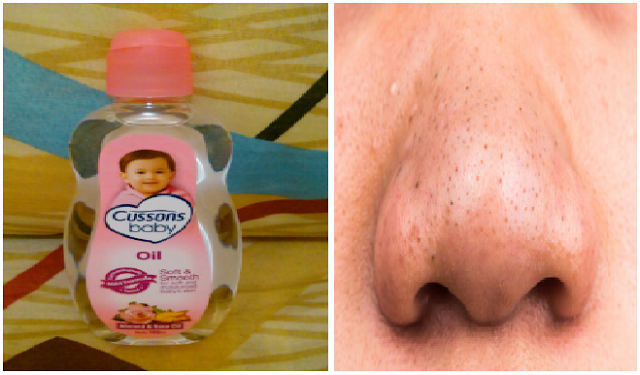 Ajaib, Cuma 5 Tetes Baby Oil Komedo di Hidung Bisa Keluar Sendiri Tanpa Rasa Sakit Ajaib, Cuma 5 Tetes Baby Oil Komedo di Hidung Bisa Keluar Sendiri Tanpa Rasa Sakit