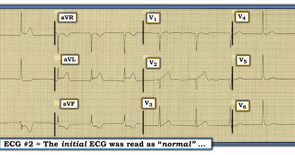 ECG Interpretation ECG Blog 170 (Atypical Chest Pain Mirror Image