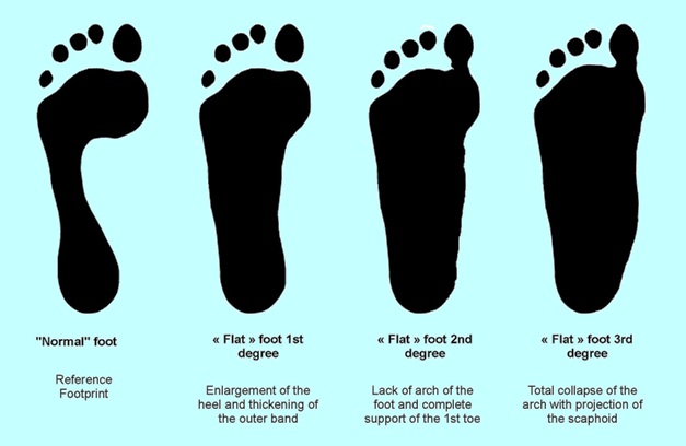 Preventing Flat Feet: Health Tip