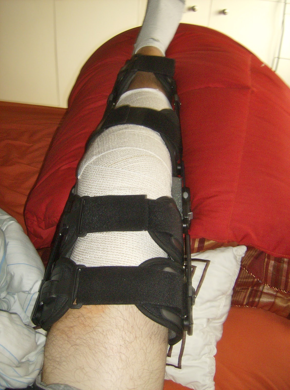 The One With the ACL Surgery: 1 Day After Surgery: Well, its fixed, right?