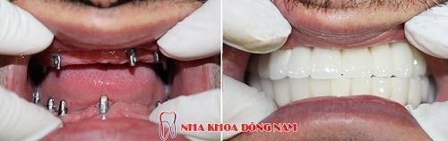 NHỮNG YẾU TỐ HỖ TRỢ GIÚP CẤY GHÉP IMPLANT KHÔNG ĐAU -6