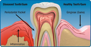 Symptoms for Gum Problems