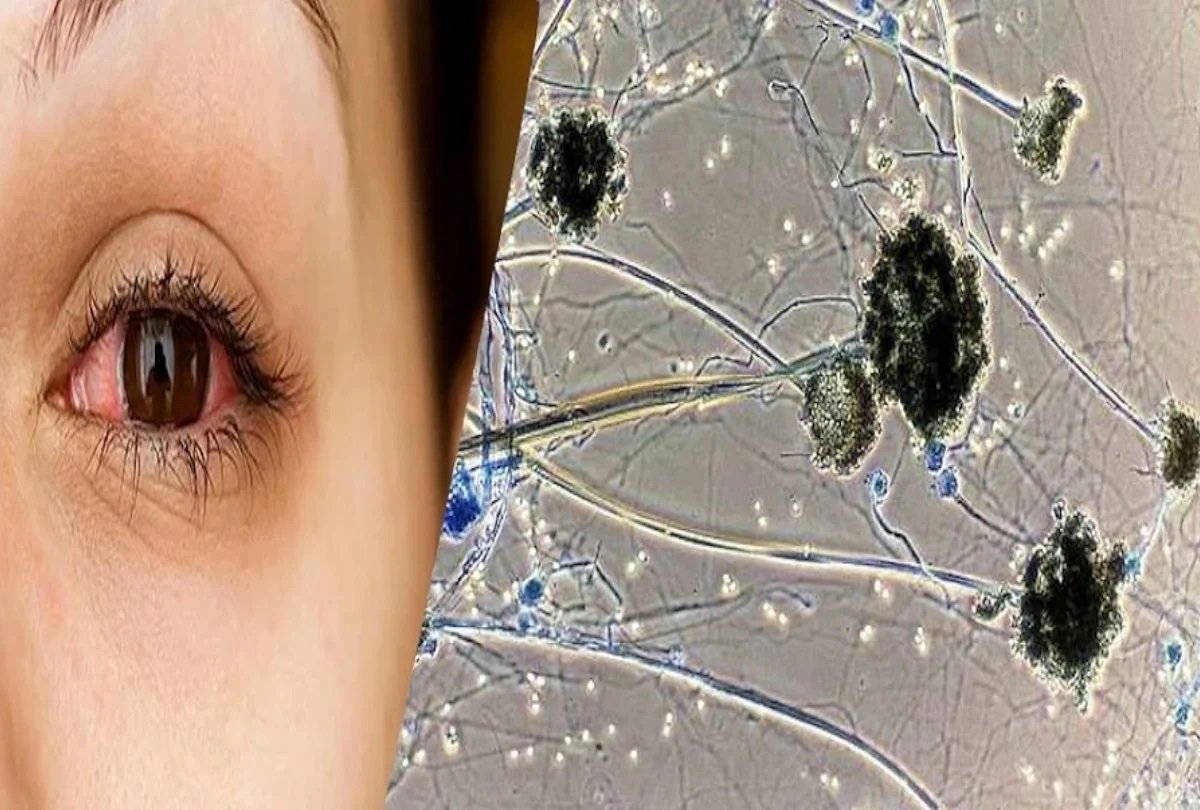 AMIT ONLINE STUDY POINT Black Fungus ,white fungus precaution tips