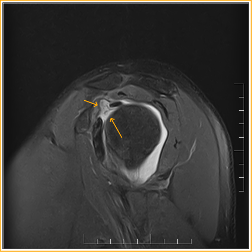 Adhesive Capsulitis MRI Sumer's Radiology Blog