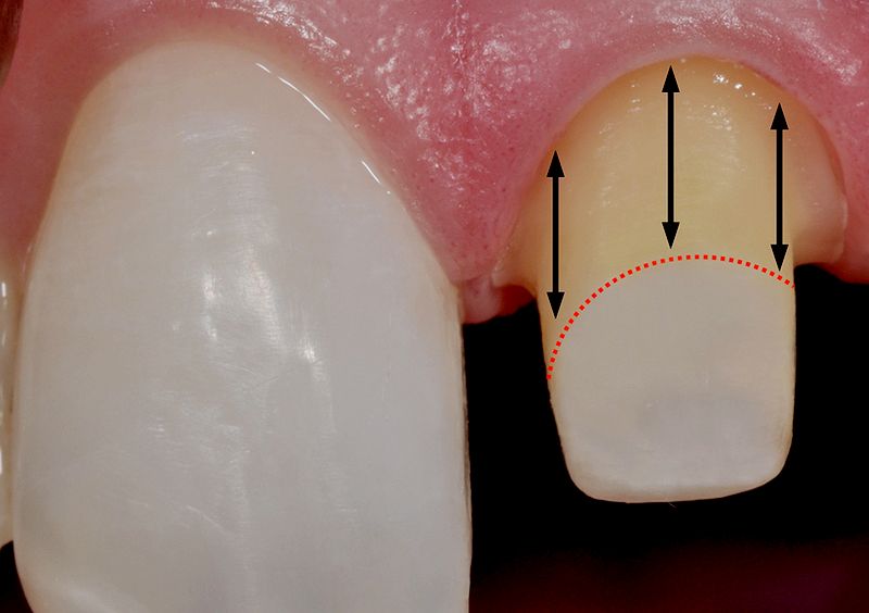 PDF Nonmetallic postendodontic restorations a systematic review