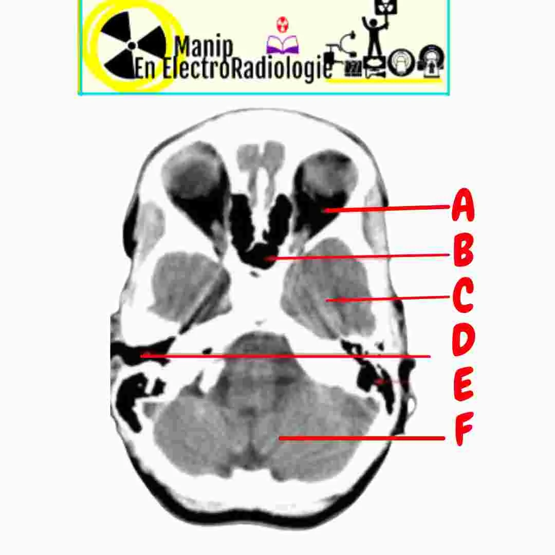 Structures anatomiques du tdm cerebrale normale au niveau de l'orbite