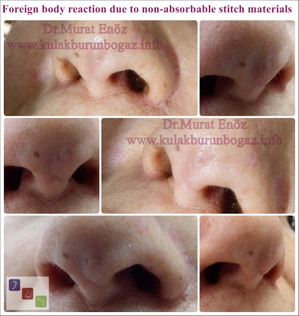 In nasal tip aesthetic surgeries, non-absorbable suture materials may cause a reaction!   During nasal tip aesthetic surgeries, tissue reaction and skin discoloration may occur due to non-absorbable suture materials. In the photo above, the nose of the patient who had nasal tip aesthetics years ago (and after the nose tip surgery was performed several times in different clinics) and after the surgery, discoloration of the nasal tip skin, pitting on the nasal tip, and then the suture material emerged from the nasal tip skin. end photos are seen. It is seen that the incision area at the tip of the nose, which should normally be indistinct, is quite prominent in the patient who has had repeated nose tip surgeries to remove the suture materials. The nasal tip area attracts attention and has a very important place in the overall facial appearance. In the operations performed on this area, the use of non-absorbable industrial products should be reduced as much as possible.
