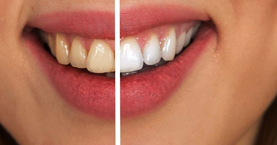 Dental Veneers in Turkey and Dentist Costs Geoffrey Chaucer