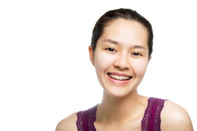 Ingin Pasang Kawat Gigi? Eits Jangan Buru-buru, Pikirkan 8 Hal Ini