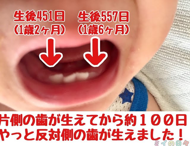 歯 赤ちゃん こんにち歯 下の歯 遅い 1歳6ヶ月