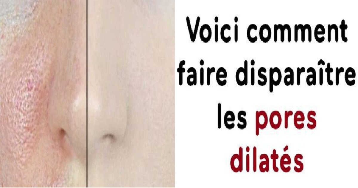 Voici Comment Faire Disparaitre Les Pores Dilates Sport Et Sante
