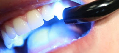 Trám răng laser tech là gì? 