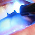 Trám răng laser tech có ưu điểm gì? 