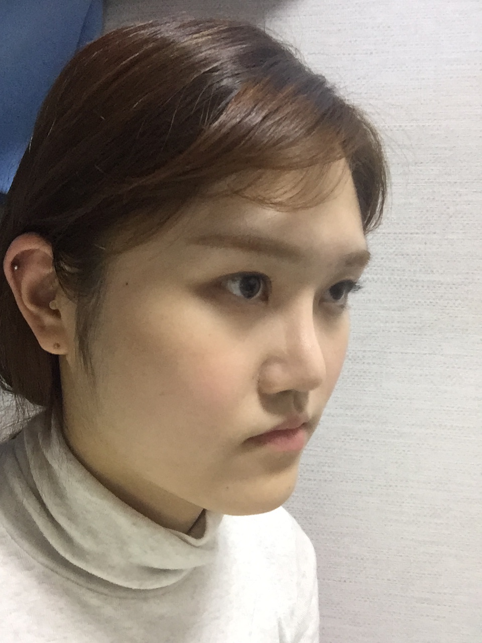 Real Patient Review Double Jaw Surgery at DA