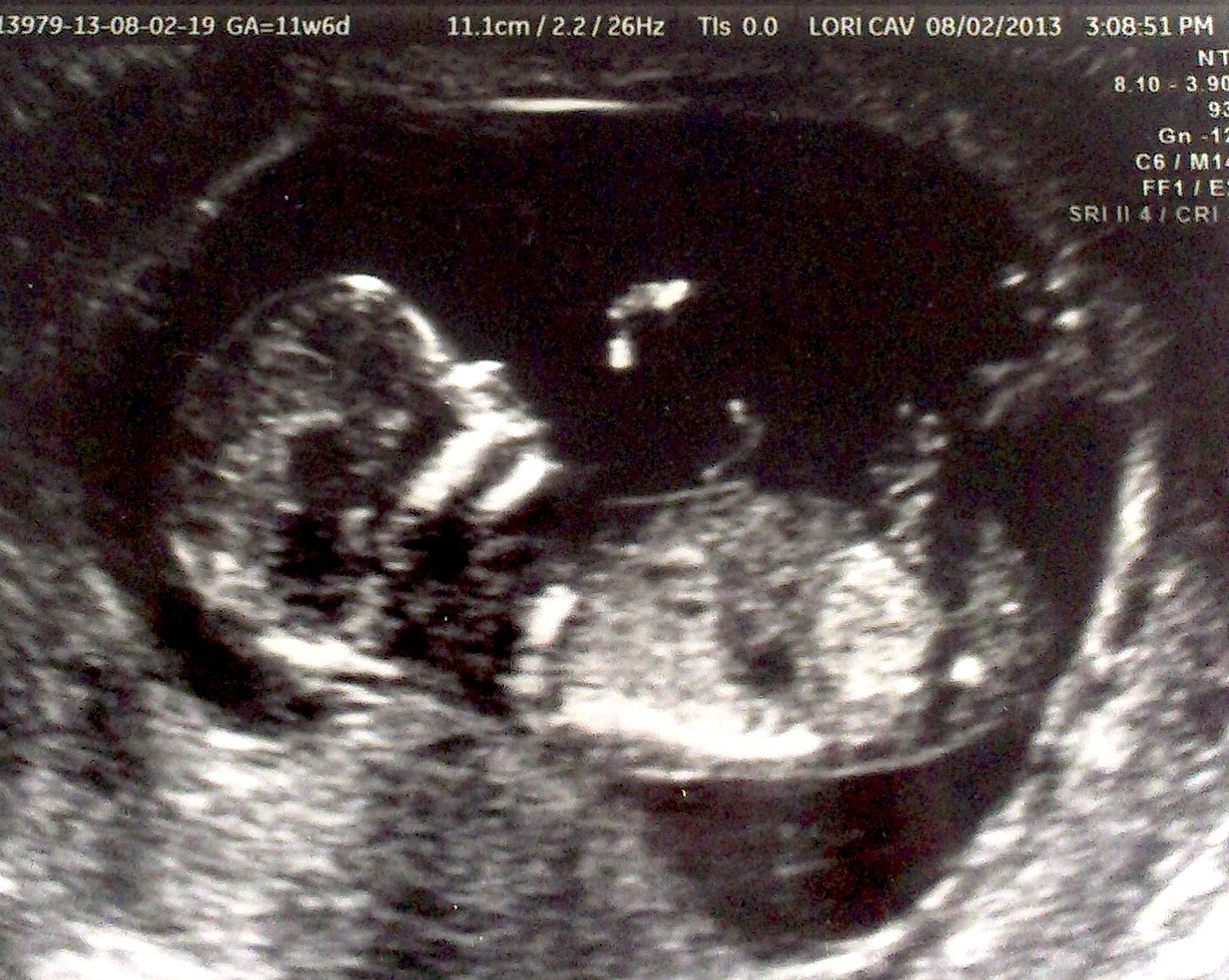 Image Of 13 Week Ultrasound