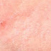 Identify Different Types Of Skin Rashes And Causes