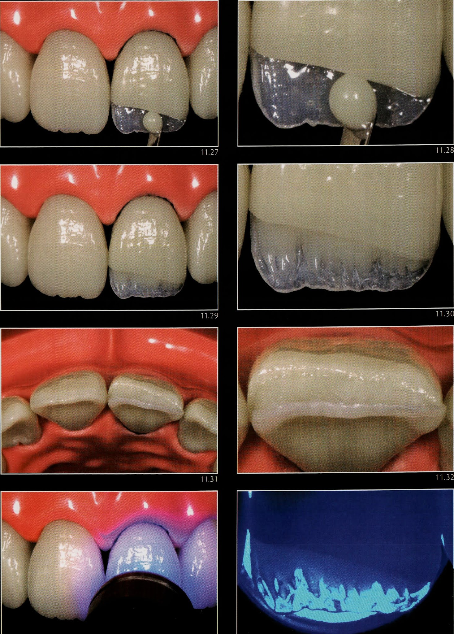 Class IV composite " silicone guide technique " Dental Esthetics