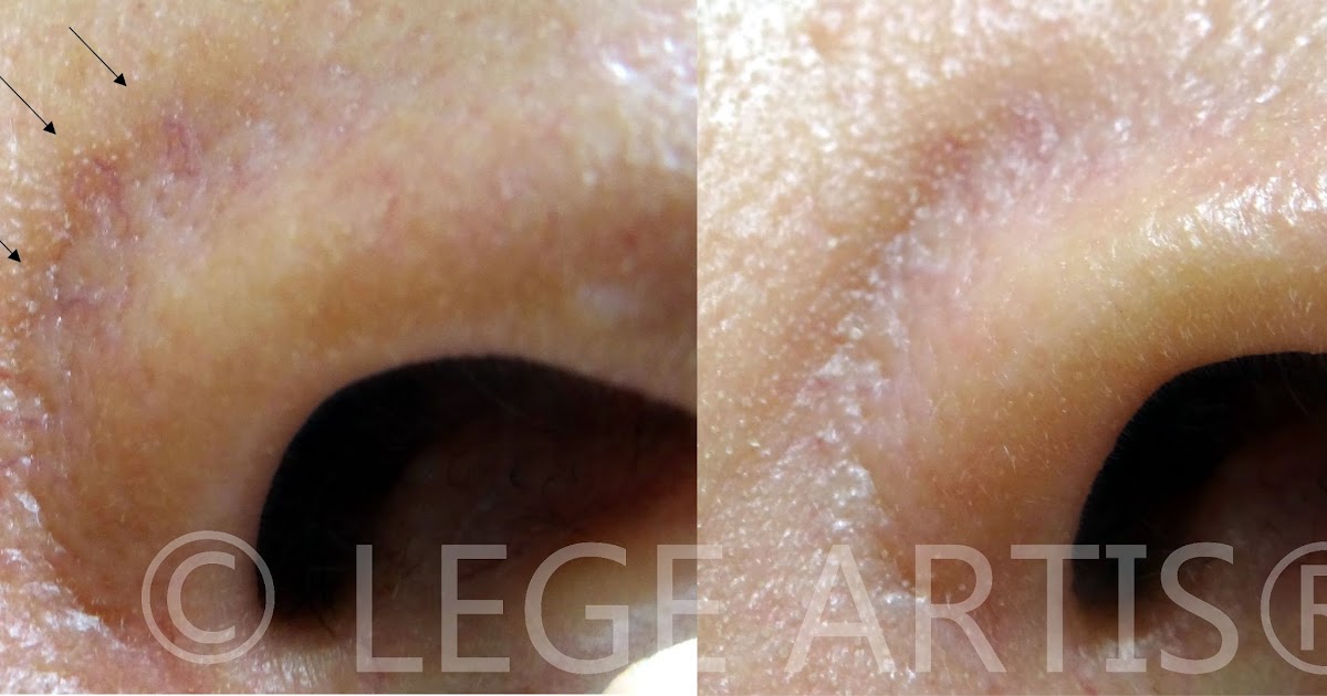 Lege Artis Blog Nose redness and dilated thread veins (capillaries