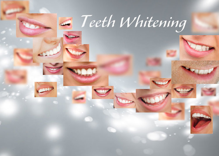 Can I Whiten Dental Crowns, Veneers, or Implants?