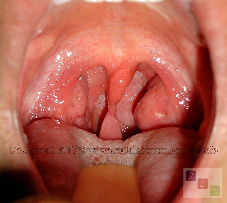 Papilloma wart in uvula Papilloma wart on my uvula Papilloma in uvula