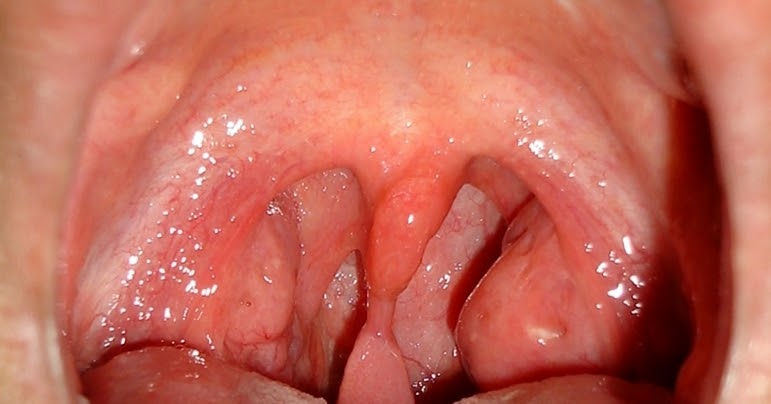 papilloma on uvula causes)