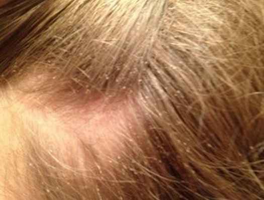 Lice Nits In Blonde Hair Caraway Seeds Health Benefits
