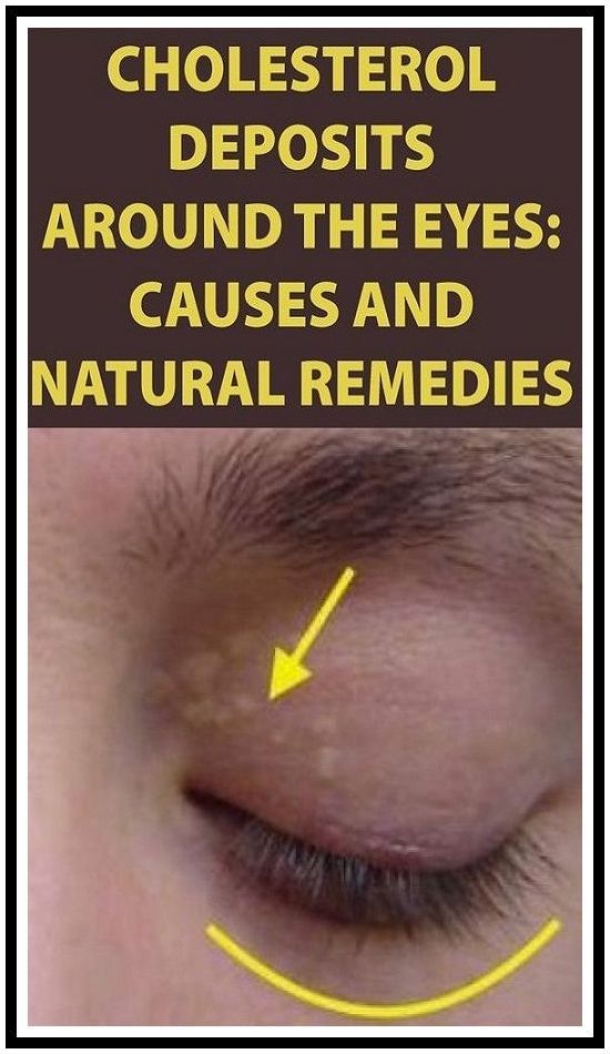 CAUSES AND NATURAL REMEDIES FOR CHOLESTEROL DEPOSITS AROUND THE EYES