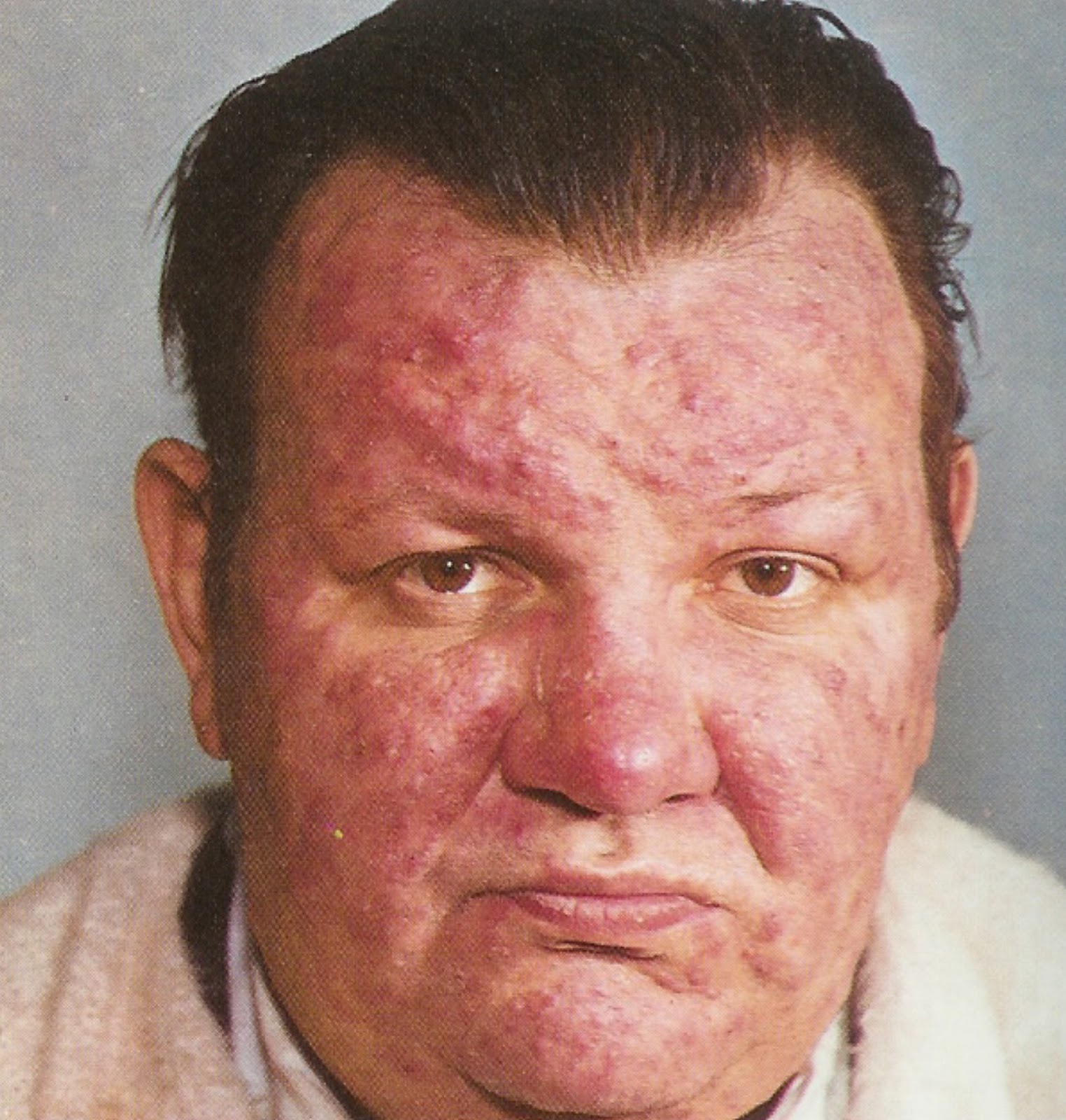 DESIGNAHOLISM Extreme Transformation of a Man with a Skin Disease using Adobe