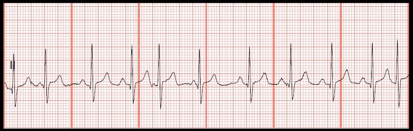 Float Nurse: Practice EKG Rhythm Strips 208