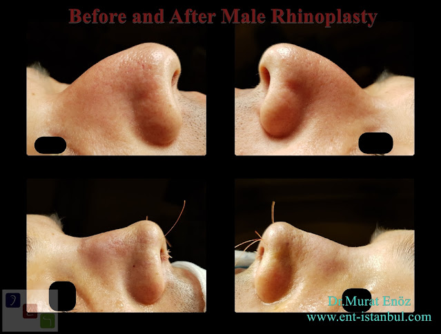 Male Rhinoplasty in Istanbul, Natural nose job for men, Male nose aesthetic surgery in Turkey