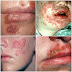 Apa Obat Untuk Penyakit  Herpes Di Bibir