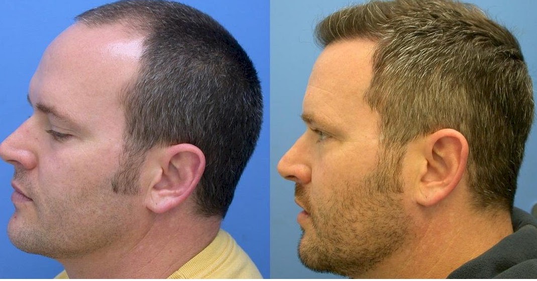 Best hair transplant Los Angeles Revive hair restoration Best Hair