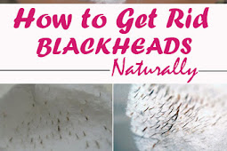 How to Get Rid of Blackheads Naturally