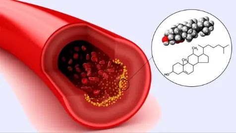 Cholesterol Tips How Low Density Lipoprotein Is Calculated Cholesterol Tips How Low Density Lipoprotein Is Calculated